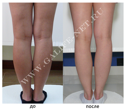 Проведена коррекция жировых отложений на голени и внутренней стороне коленей.